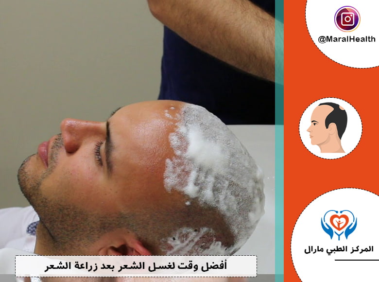 أفضل وقت لغسل الشعر بعد زراعة الشعر