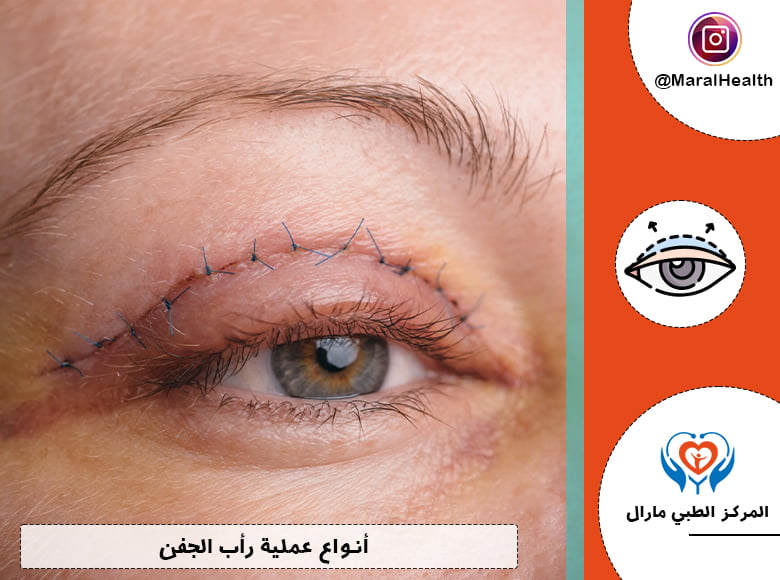 أنواع عملية رأب الجفن