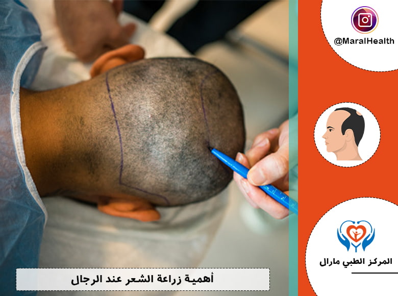 أهمية زراعة الشعر عند الرجال
