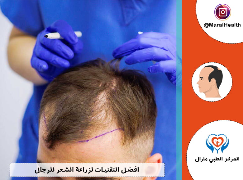 افضل التقنيات لزراعة الشعر للرجال