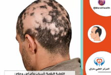 الثعلبة البقعية | المرکز الطبي مارال