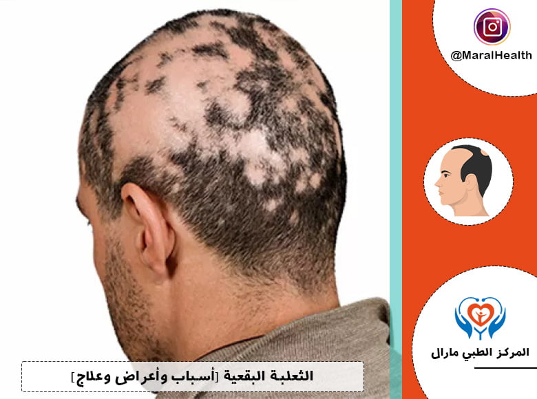 الثعلبة البقعية | المرکز الطبي مارال