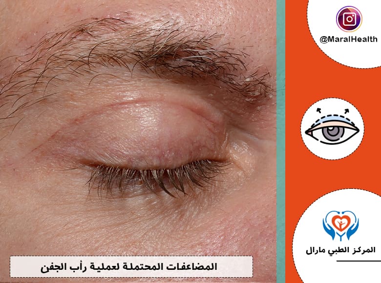 المضاعفات المحتملة لعملية رأب الجفن