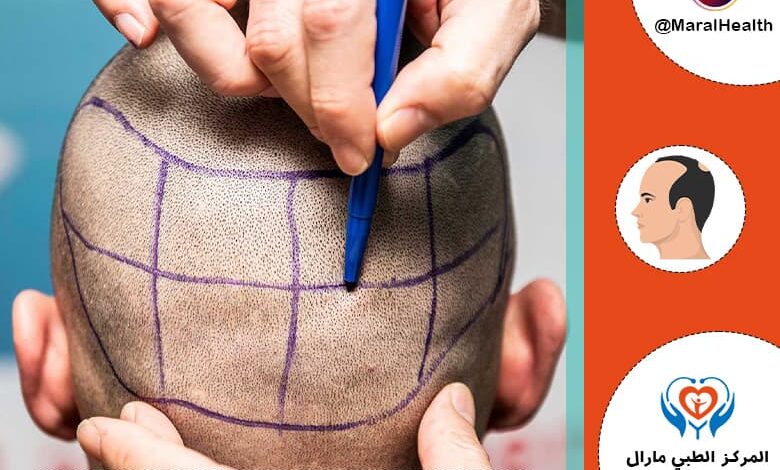 المنطقة المانحة في زرع الشعر | المرکز الطبي مارال