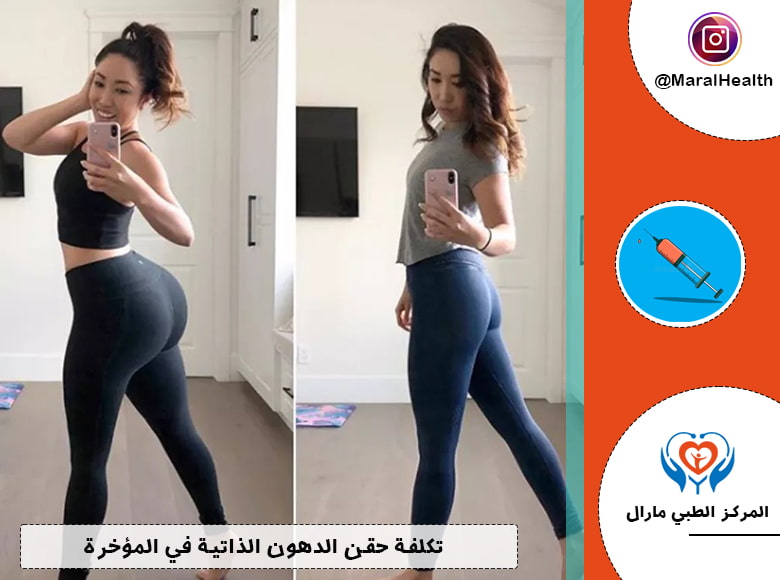 تكلفة حقن الدهون الذاتية في المؤخرة