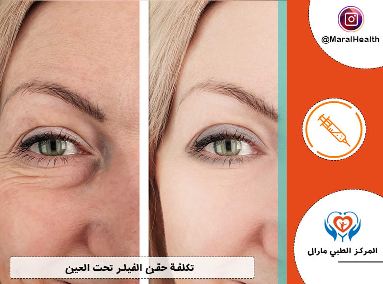 تكلفة حقن الفيلر تحت العين