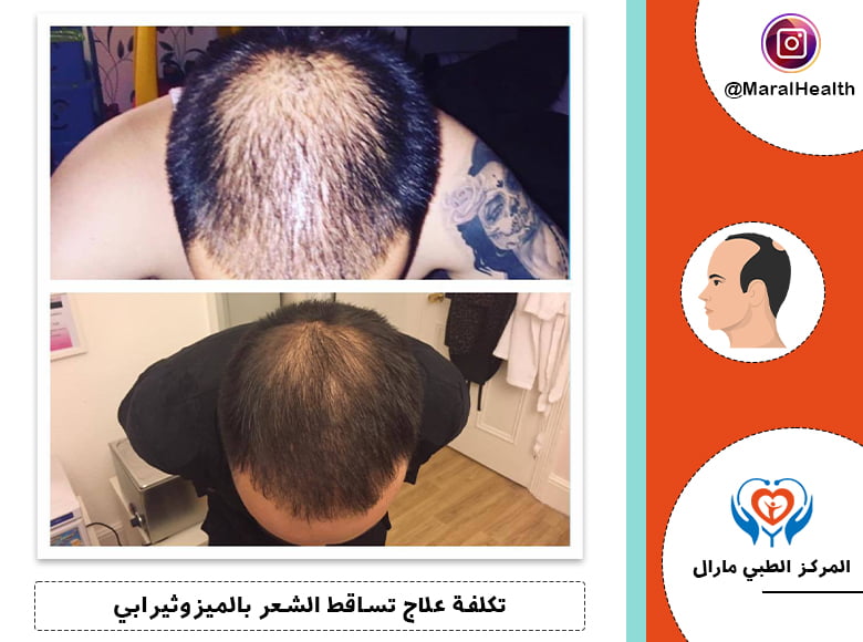 تكلفة علاج تساقط الشعر بالميزوثيرابي
