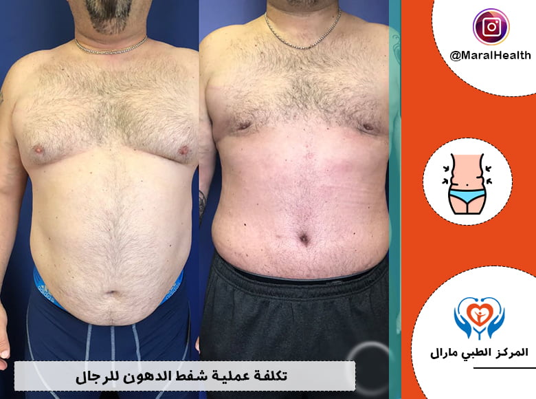 تكلفة عملية شفط الدهون للرجال