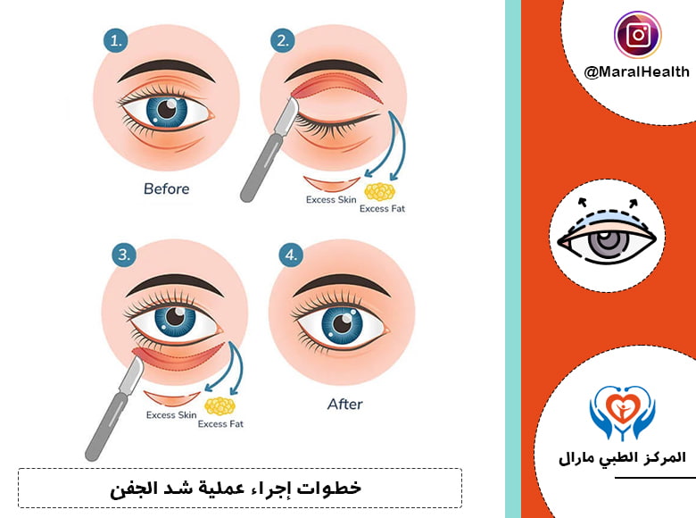 خطوات إجراء عملية شد الجفن
