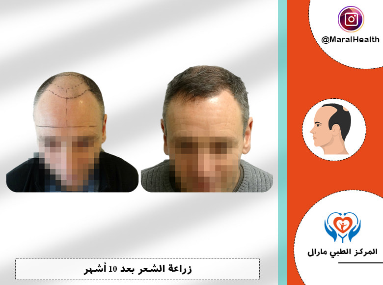 زراعة-الشعر بعد 10 أشهر