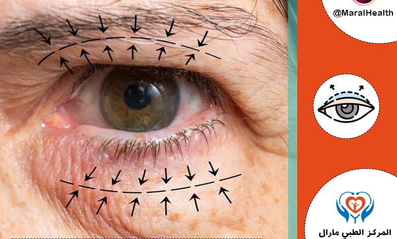 عملية شد الجفون بنسبة نجاح عالية [2023] - المرکز الطبي مارال - 2023