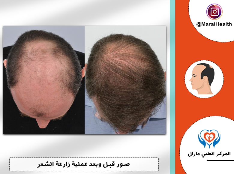 شكل الشعر المزروع