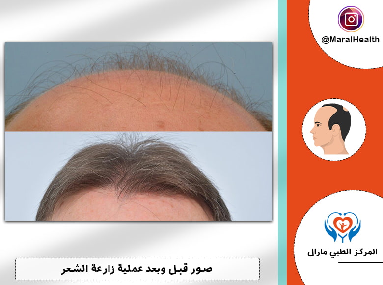 صور قبل وبعد زراعة الشعر الطبيعي