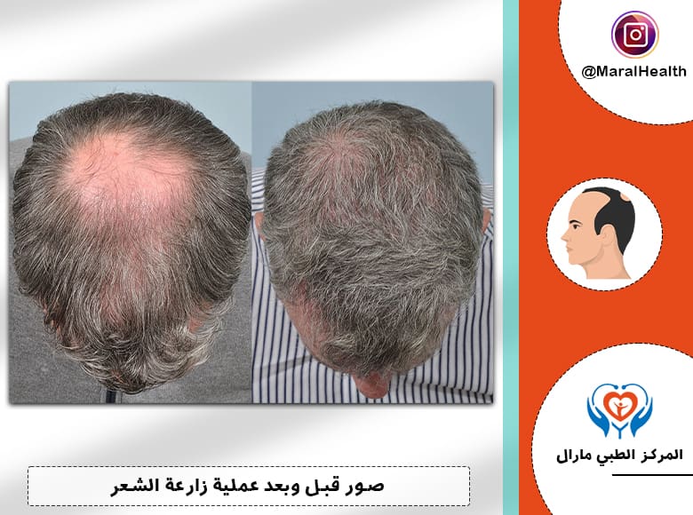 صور نمو الشعر المزروع بعد عملية زراعة الشعر