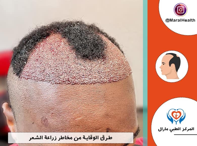 طرق الوقاية من مخاطر زراعة الشعر