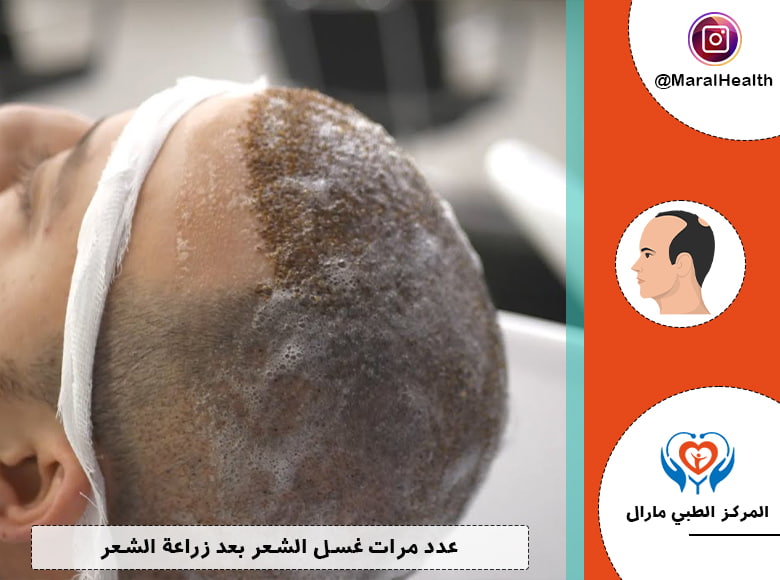 عدد مرات غسل الشعر بعد زراعة الشعر