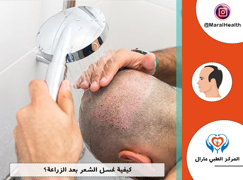 كيفية غسل الشعر بعد الزراعة؟