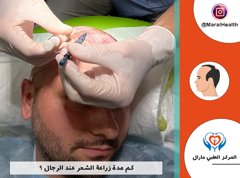 كم مدة زراعة الشعر عند الرجال ؟