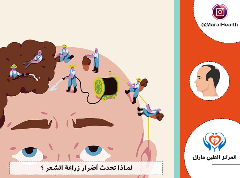لماذا تحدث أضرار زراعة الشعر ؟