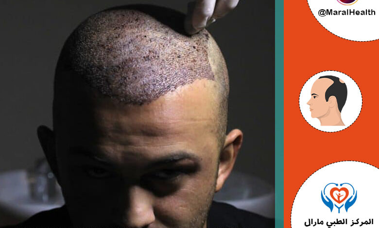 مخاطر وأضرار زراعة الشعر | المرکز الطبي مارال