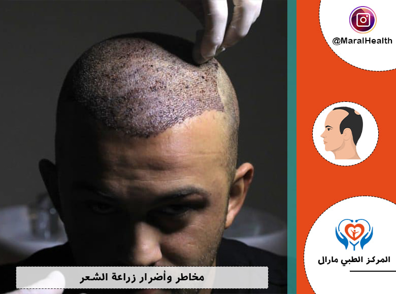 مخاطر وأضرار زراعة الشعر | المرکز الطبي مارال