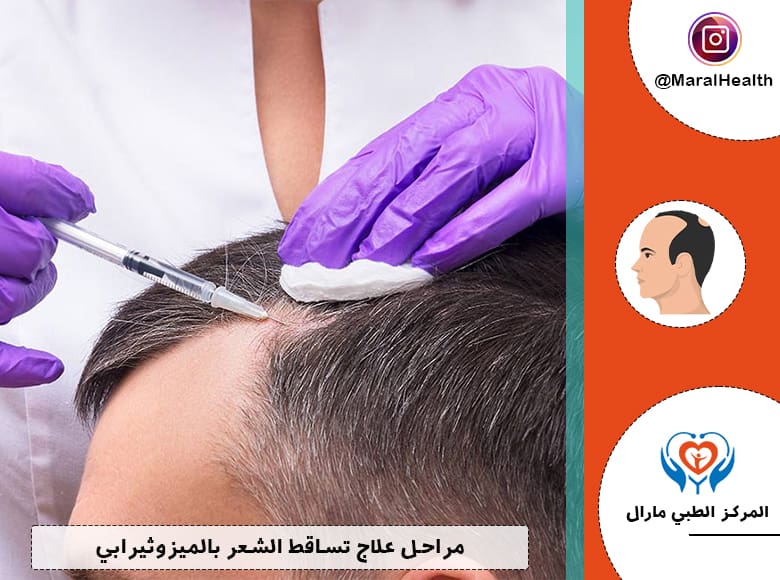 مراحل علاج تساقط الشعر بالميزوثيرابي