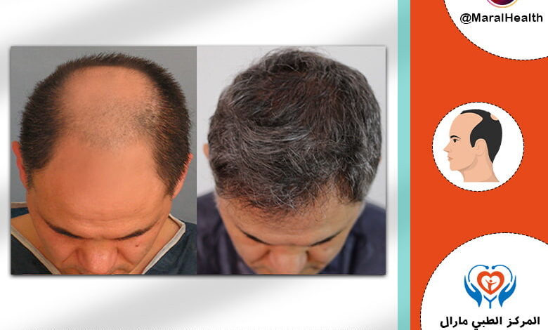 نتائج زراعة الشعر