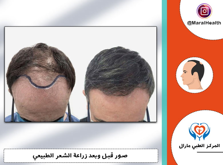 نتائج زراعة الشعر للرجال