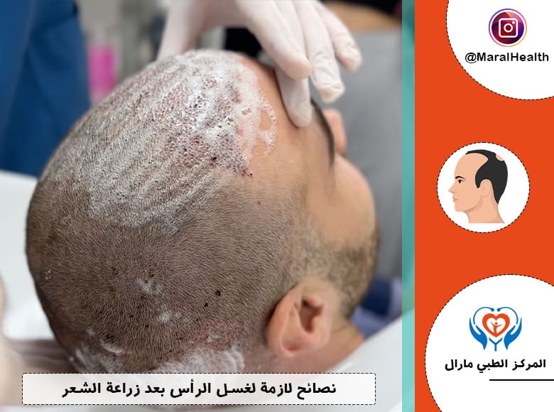نصائح لازمة لغسل الرأس بعد زراعة الشعر