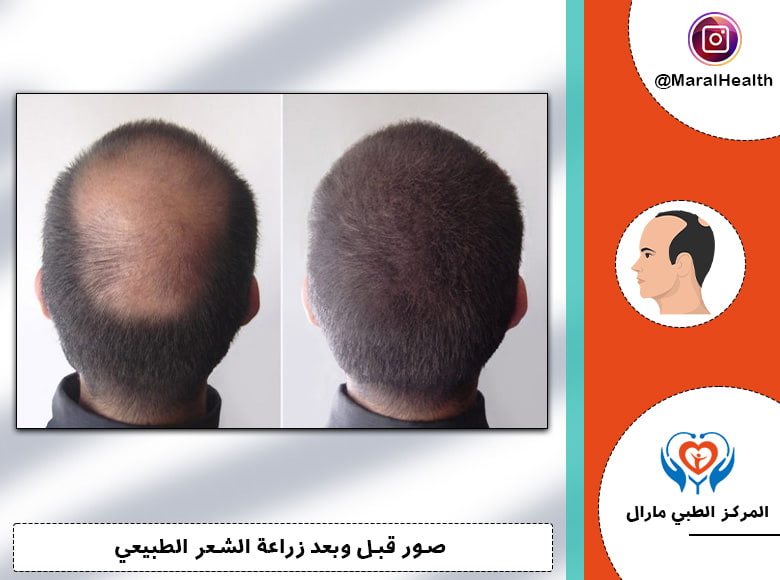 أفضل عيادة زراعة الشعر من وجهة نظر الناس