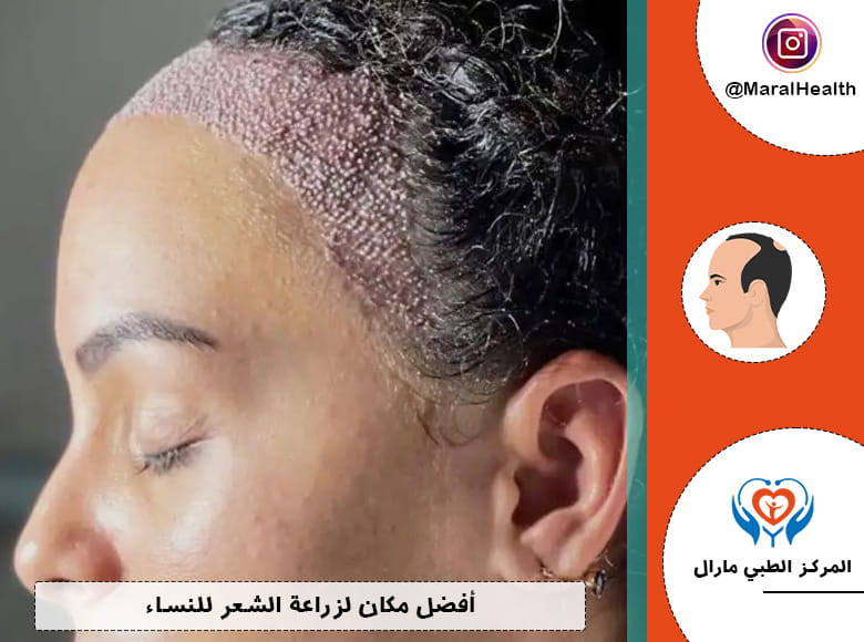 أفضل مكان لزراعة الشعر للنساء
