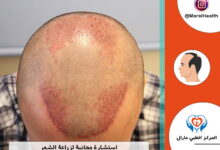 استشارة مجانية لزراعة الشعر | المرکز الطبي مارال