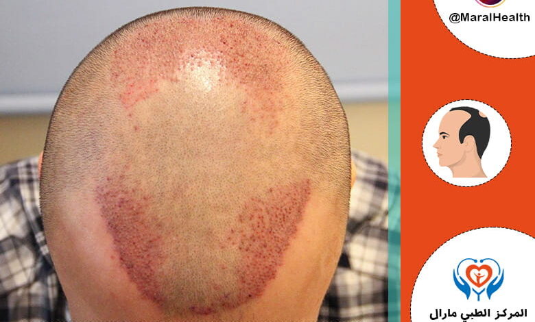 استشارة مجانية لزراعة الشعر | المرکز الطبي مارال