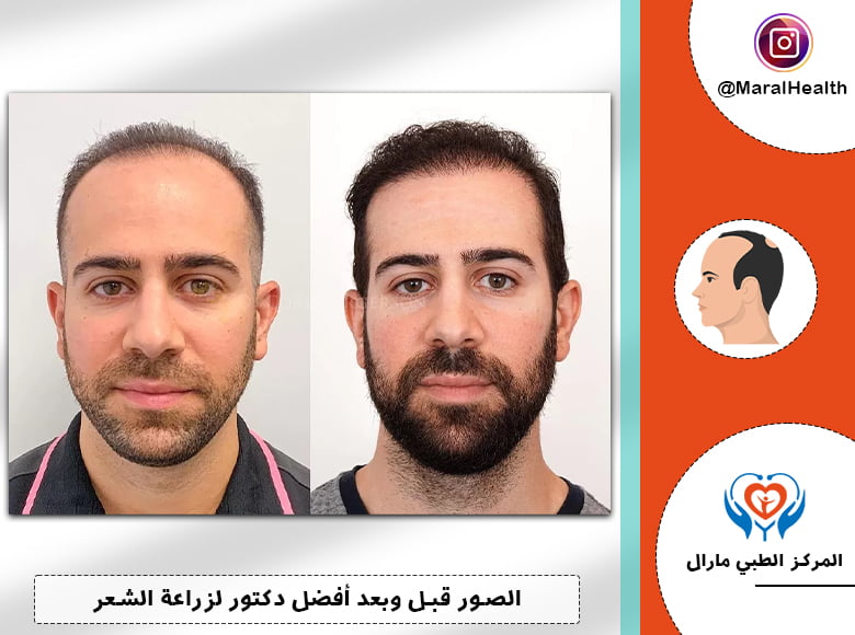الصور قبل وبعد أفضل دكتور لزراعة الشعر