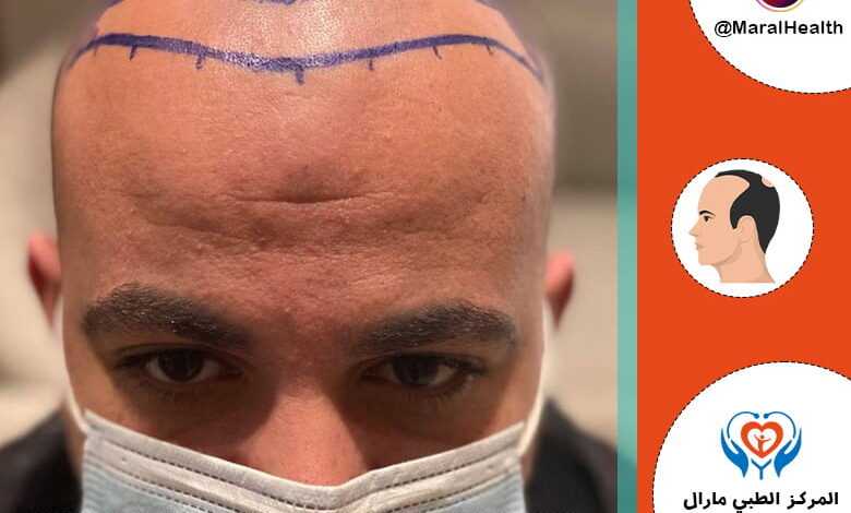 ما هو أفضل العمر والوقت لزراعة الشعر؟ - المرکز الطبي مارال