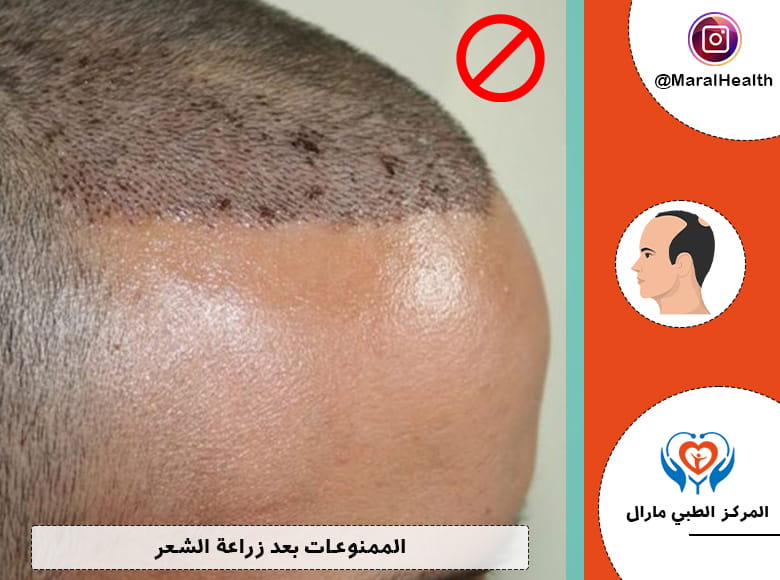 الممنوعات بعد زراعة الشعر