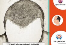 متى تثبت البصيلات بعد زراعة الشعر ؟
