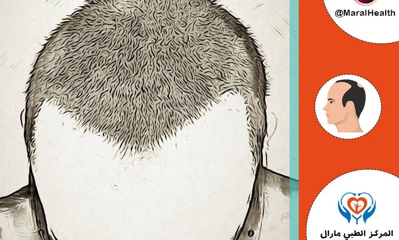 متى تثبت البصيلات بعد زراعة الشعر ؟