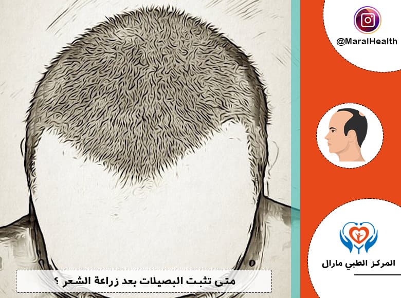 متى تثبت البصيلات بعد زراعة الشعر ؟