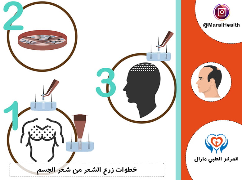 خطوات زرع الشعر من شعر الجسم