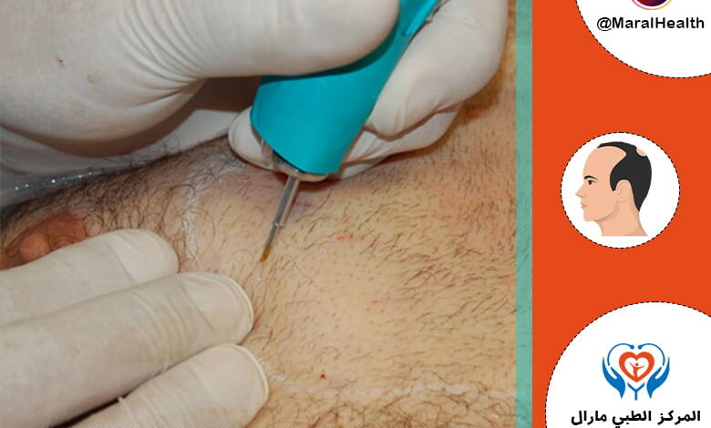 زراعة الشعر باستخدام شعر الجسم - تقنية BHT | المرکز الطبي مارال
