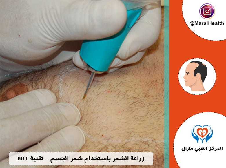 زراعة الشعر باستخدام شعر الجسم - تقنية BHT | المرکز الطبي مارال