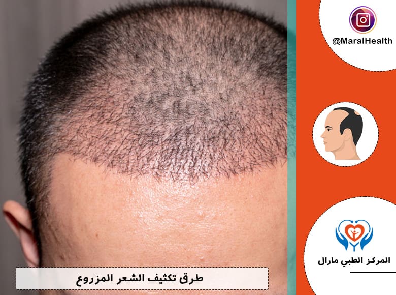 طرق تكثيف الشعر المزروع