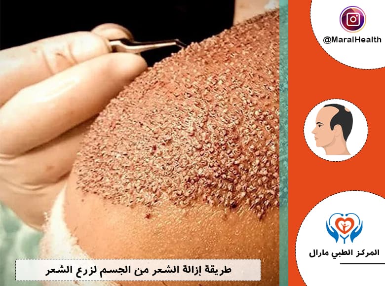 طريقة إزالة الشعر من الجسم لزرع الشعر