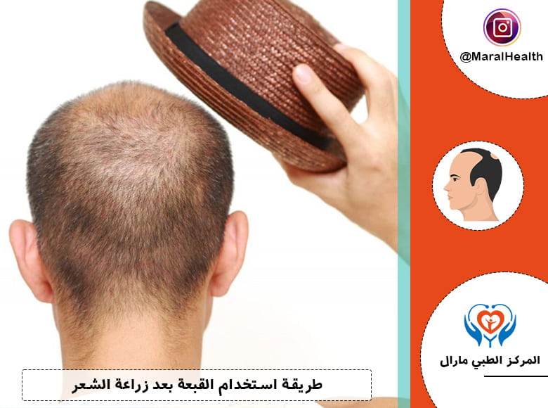 طريقة استخدام القبعة بعد زراعة الشعر