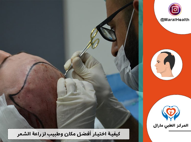 كيفية اختيار أفضل مكان وطبيب لزراعة الشعر