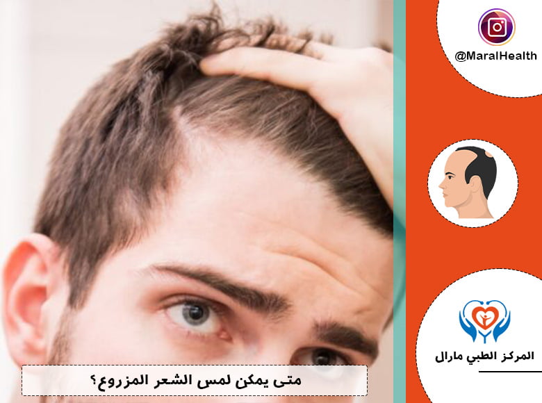متى يمكن لمس الشعر المزروع؟