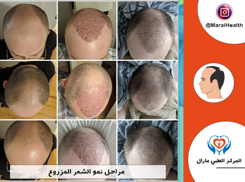 مراحل نمو الشعر المزروع