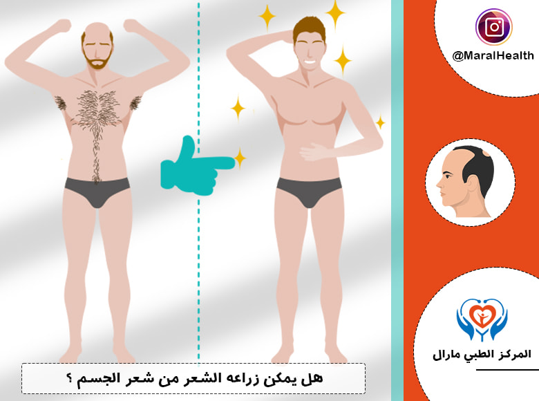 هل يمكن زراعه الشعر من شعر الجسم ؟