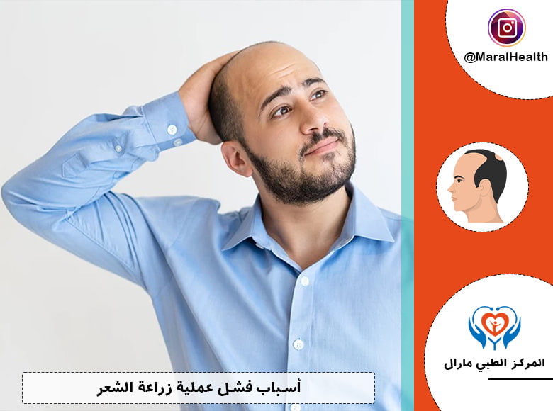 أسباب فشل عملية زراعة الشعر